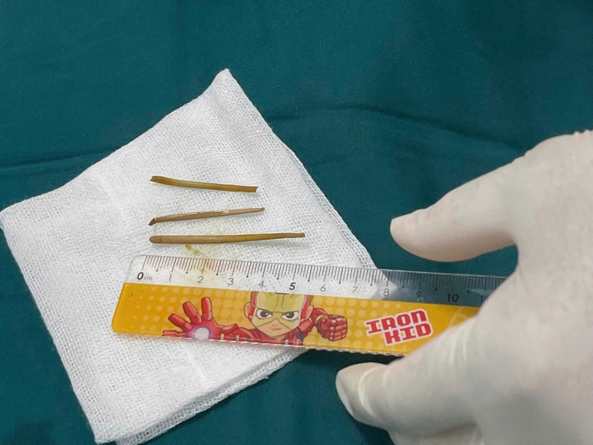 Bệnh viện 22-12 đã nội soi và lấy ra 3 dị vật nằm trong đại tràng của bệnh nhân hơn 1 năm