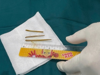 Bệnh viện 22-12 đã nội soi và lấy ra 3 dị vật nằm trong đại tràng của bệnh nhân hơn 1 năm