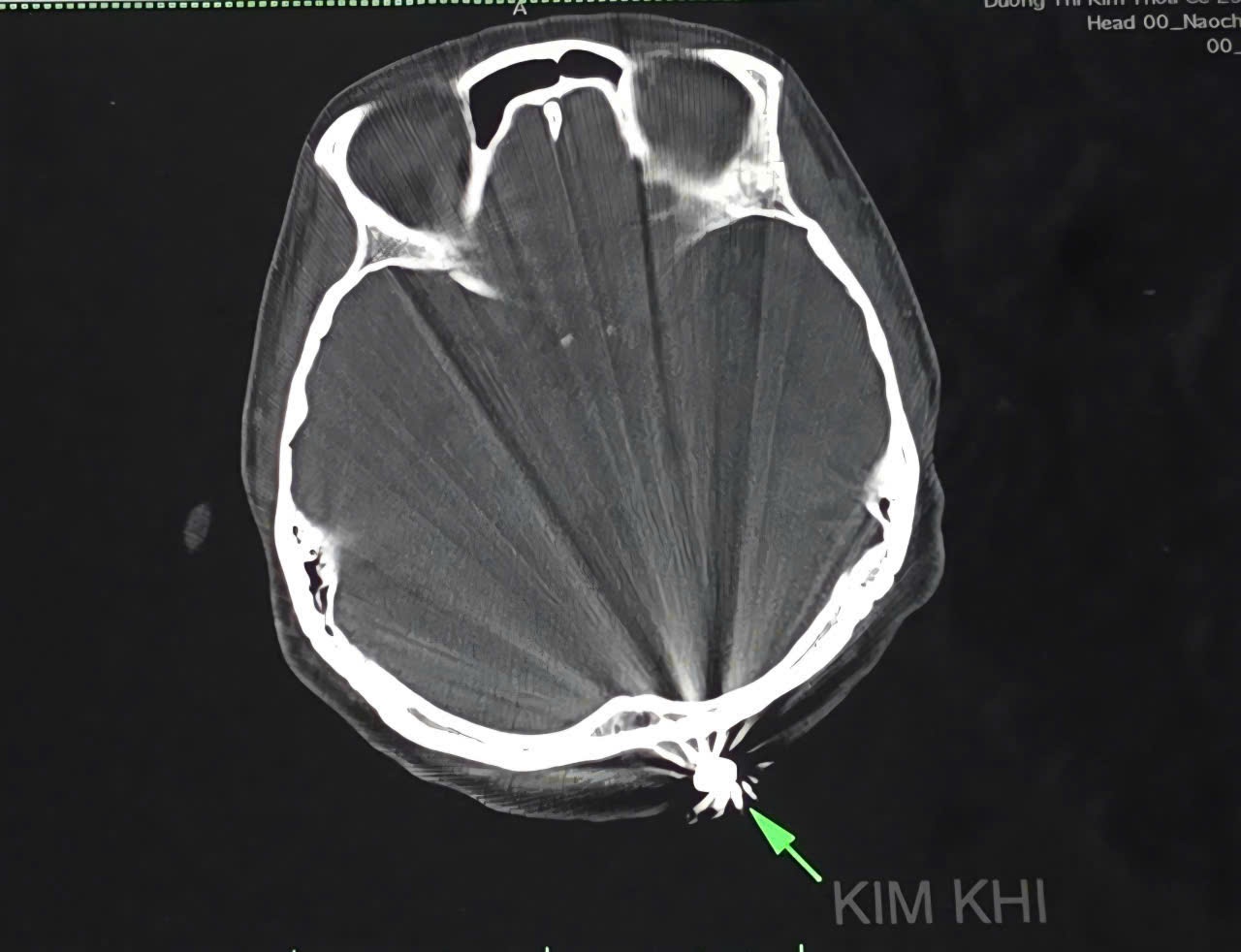 Phẫu thuật thành công một phụ nữ ở Cần Thơ bị đạn lạc trúng đầu khi đang làm vườn