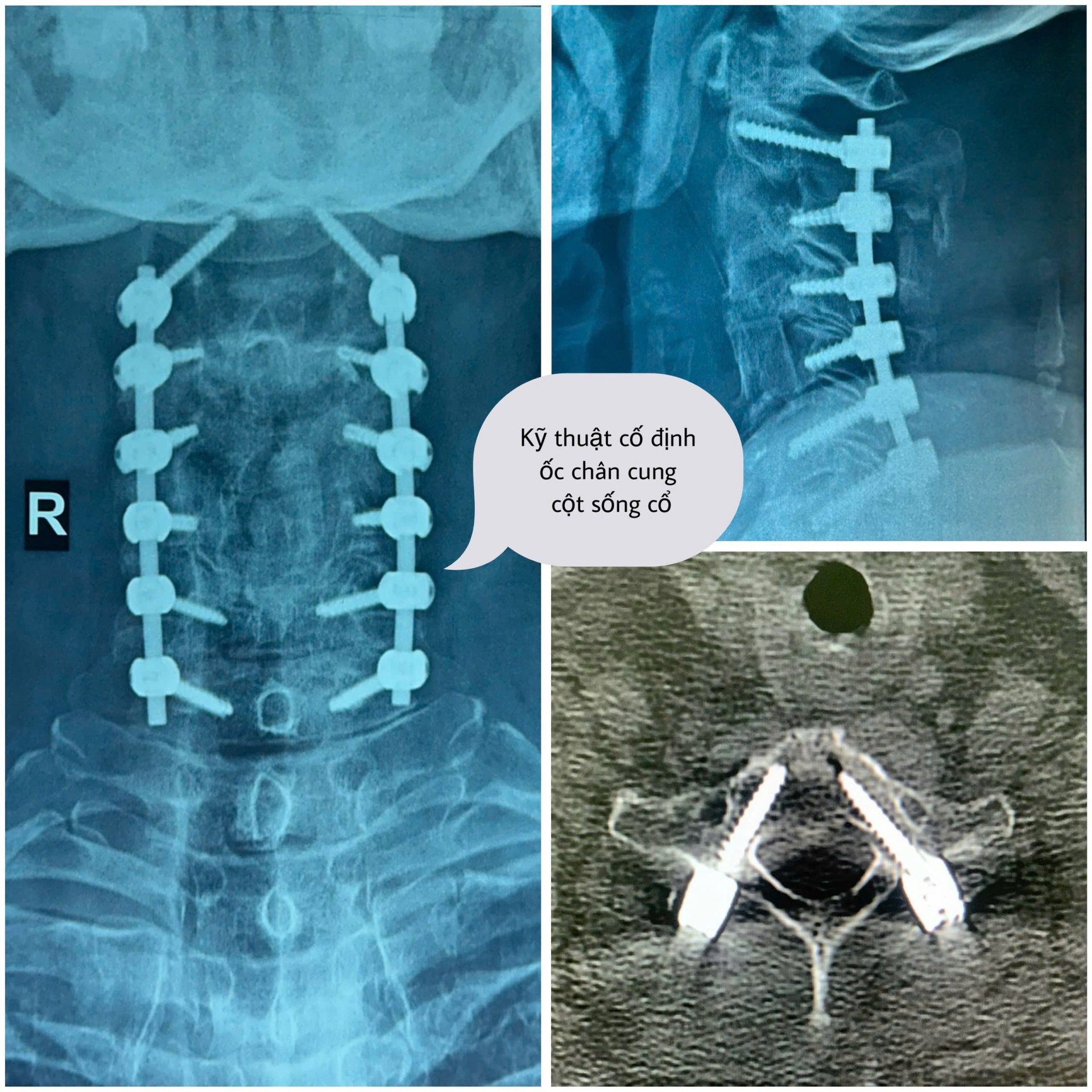 Bệnh viện Đa khoa Khánh Hòa: Ứng dụng thành công kỹ thuật phẫu thuật đặt ốc chân cung cố định cột sống cổ