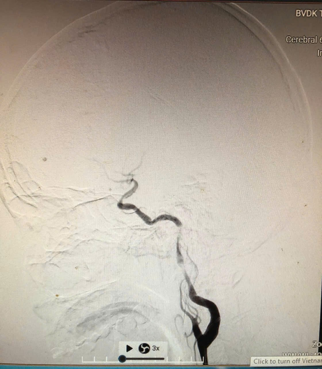 Hình ảnh chụp mạch máu não (DSA) trước can thiệp cho thấy động mạch cảnh trong bên trái bị hẹp nặng và tắc đoạn, dòng chảy máu lên não bị hạn chế rõ rệt