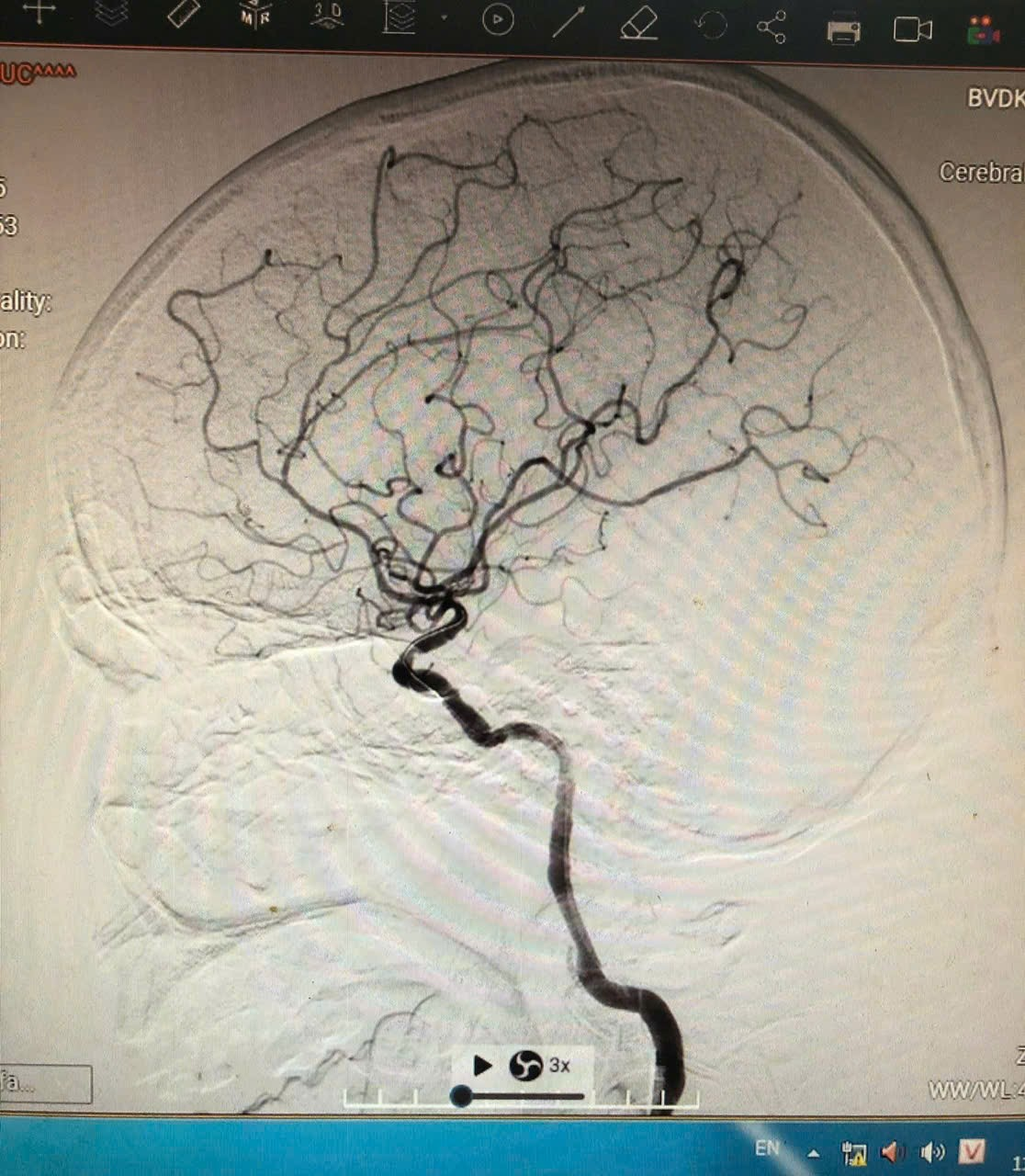 Hình ảnh chụp mạch máu não kỹ thuật số xóa nền (DSA) cho thấy hệ thống động mạch não bên trái được tái thông hoàn toàn sau can thiệp, dòng chảy máu lên các nhánh não rõ nét và liên tục