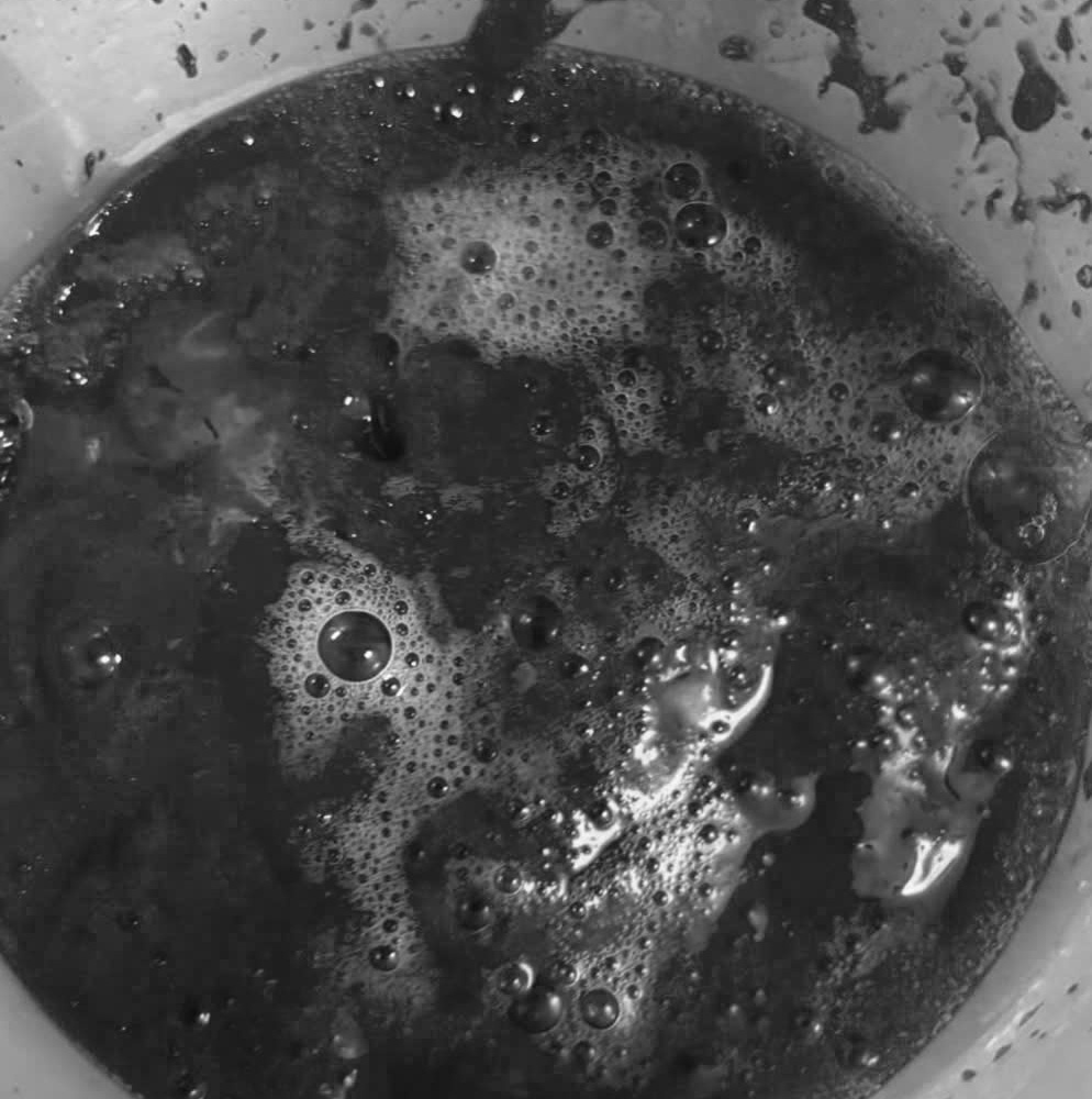 Cứu sống bệnh nhân thoát khỏi “cửa tử” nhờ can thiệp tắc mạch phế quản Cứu sống bệnh nhân thoát khỏi “cửa tử” nhờ can thiệp tắc mạch phế quản