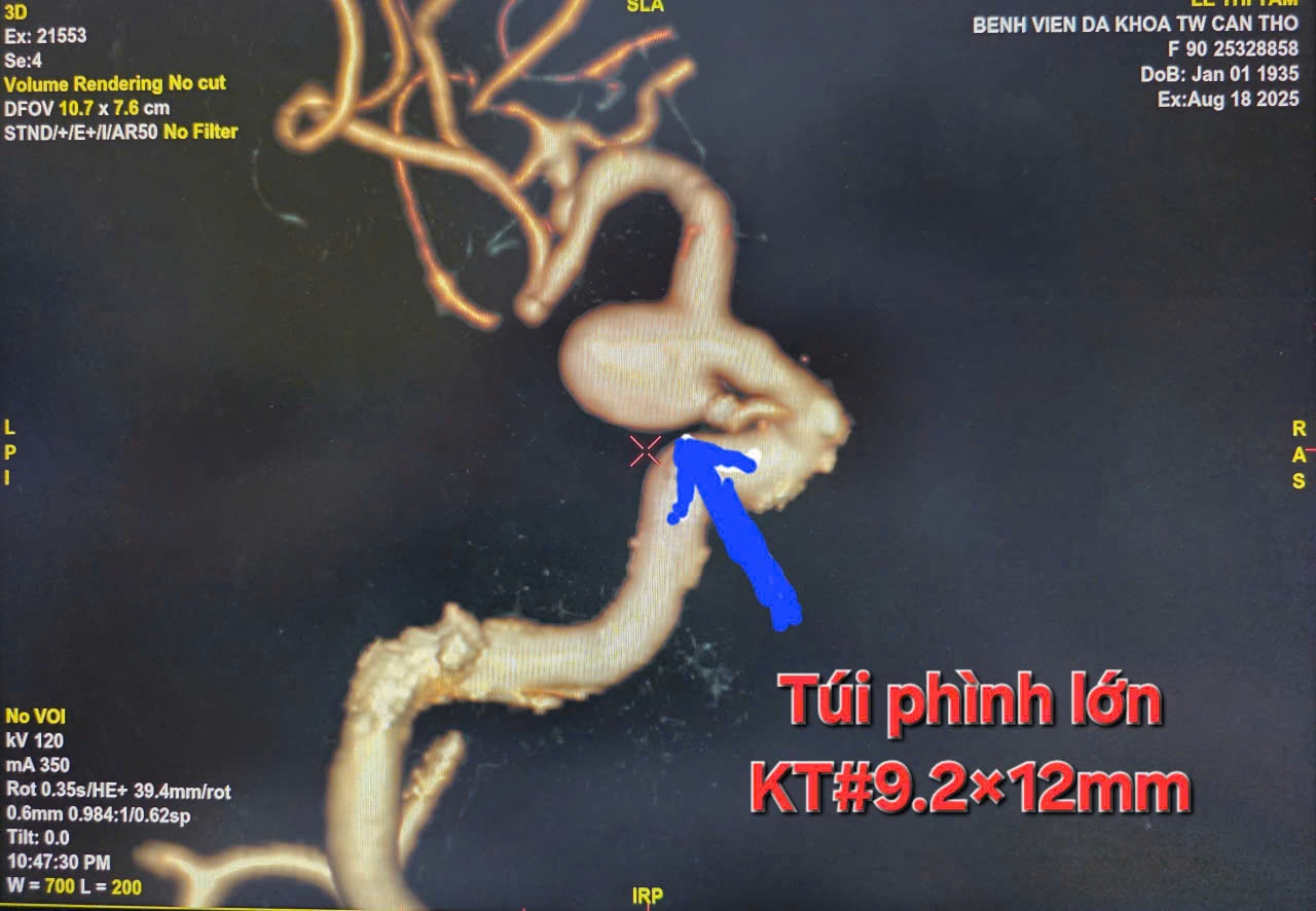 Can thiệp thành công phình mạch não cho bệnh nhân 90 tuổi