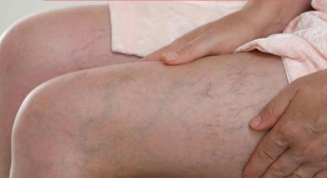 Bệnh giãn tĩnh mạch triệu chứng, chữa trị và phòng ngừa