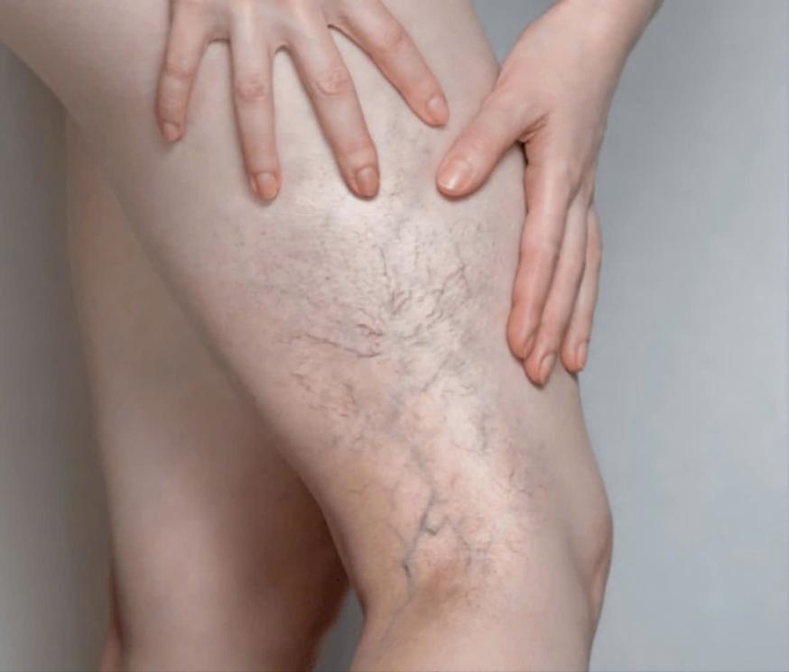 Bệnh giãn tĩnh mạch triệu chứng, chữa trị và phòng ngừa