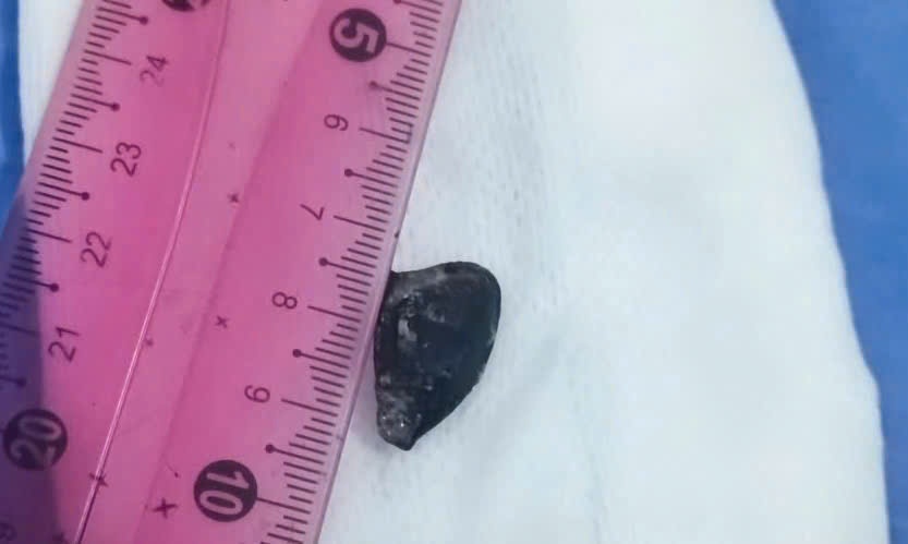 Lấy hạt hồng xiêm bị bỏ quên hơn 10 năm trong phế quản bệnh nhân Lấy hạt hồng xiêm bị bỏ quên hơn 10 năm trong phế quản bệnh nhân