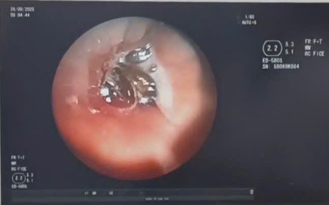 Lấy hạt hồng xiêm bị bỏ quên hơn 10 năm trong phế quản bệnh nhân Lấy hạt hồng xiêm bị bỏ quên hơn 10 năm trong phế quản bệnh nhân