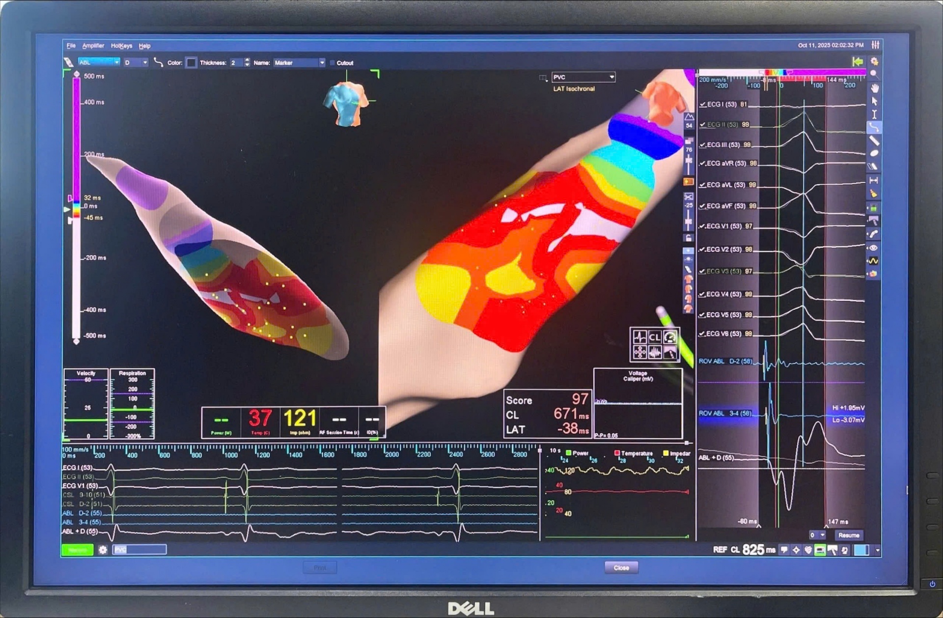 Bệnh viện Đa khoa Quốc tế S.I.S Cần Thơ: Can thiệp giúp bệnh nhân rối loạn nhịp tim lấy lại nhịp sống khỏe mạnh Bệnh viện Đa khoa Quốc tế S.I.S Cần Thơ: Can thiệp giúp bệnh nhân rối loạn nhịp tim lấy lại nhịp sống khỏe mạnh