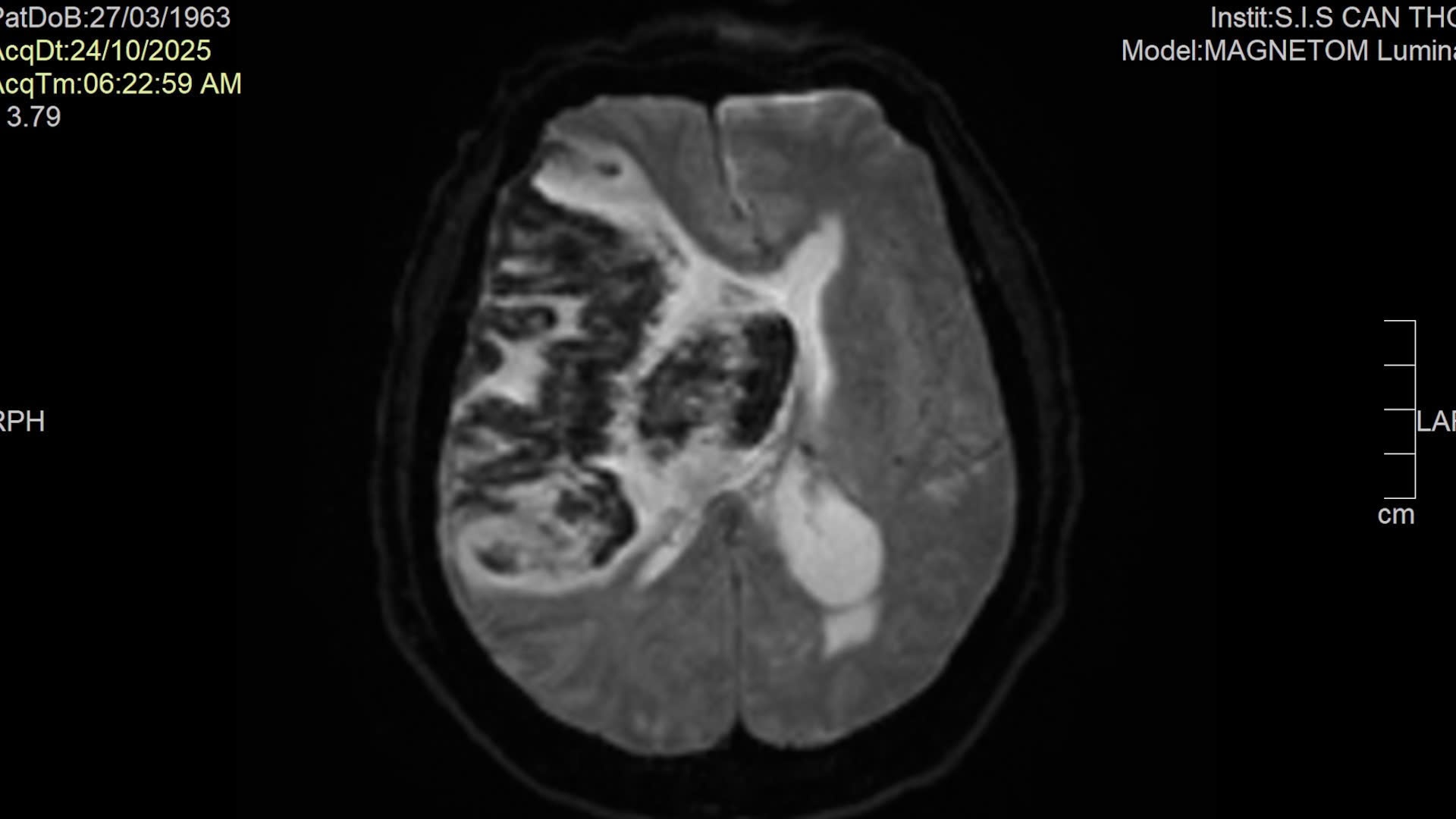 Bệnh viện Đa khoa Quốc tế S.I.S Cần Thơ : Cứu sống bệnh nhân bị đột quỵ não.