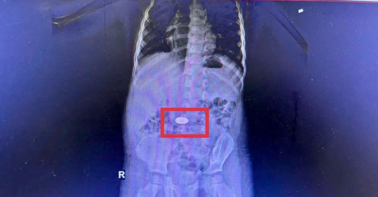 Chỉ trong 1 tháng có 5 trẻ phải nội soi khẩn cấp để gắp đồng xu bị hóc Chỉ trong 1 tháng có 5 trẻ phải nội soi khẩn cấp để gắp đồng xu bị hóc