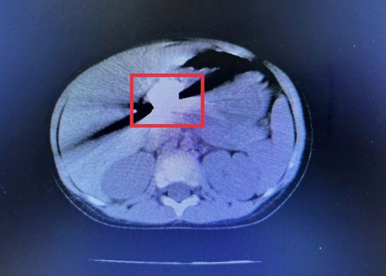 Chỉ trong 1 tháng có 5 trẻ phải nội soi khẩn cấp để gắp đồng xu bị hóc Chỉ trong 1 tháng có 5 trẻ phải nội soi khẩn cấp để gắp đồng xu bị hóc