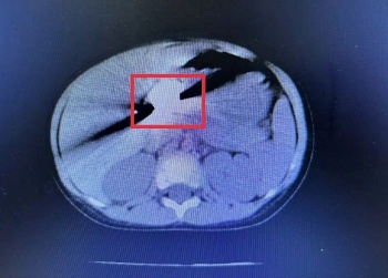 Chỉ trong 1 tháng có 5 trẻ phải nội soi khẩn cấp để gắp đồng xu bị hóc