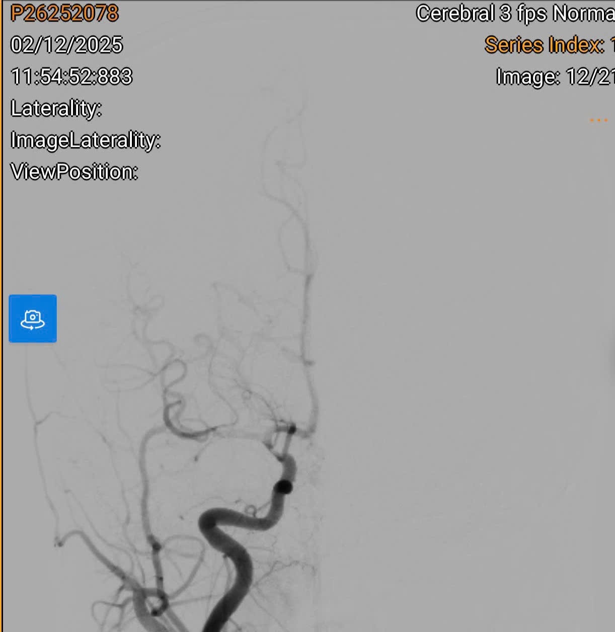   Đây là hình ảnh tắc mạch trước can thiệp