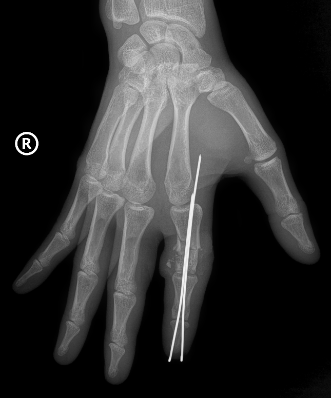 Vi phẫu thành công cứu sống ngón tay thủy thủ bị đứt rời sau 25 giờ