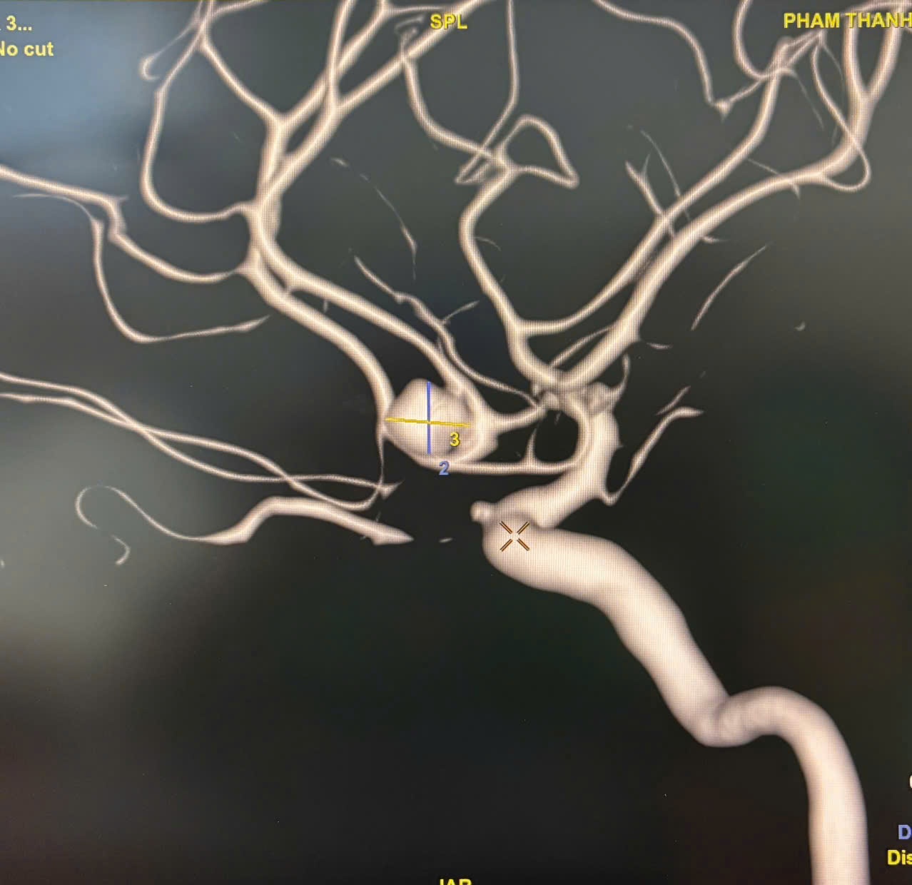 Bệnh viện Quân y 121 (Quân khu 9) thực hiện thành công ca can thiệp nút túi phình động mạch não Bệnh viện Quân y 121 (Quân khu 9) thực hiện thành công ca can thiệp nút túi phình động mạch não