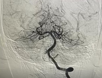 Can thiệp nội mạch giúp bé trai bị đột quỵ tránh được nguy cơ liệt nửa người