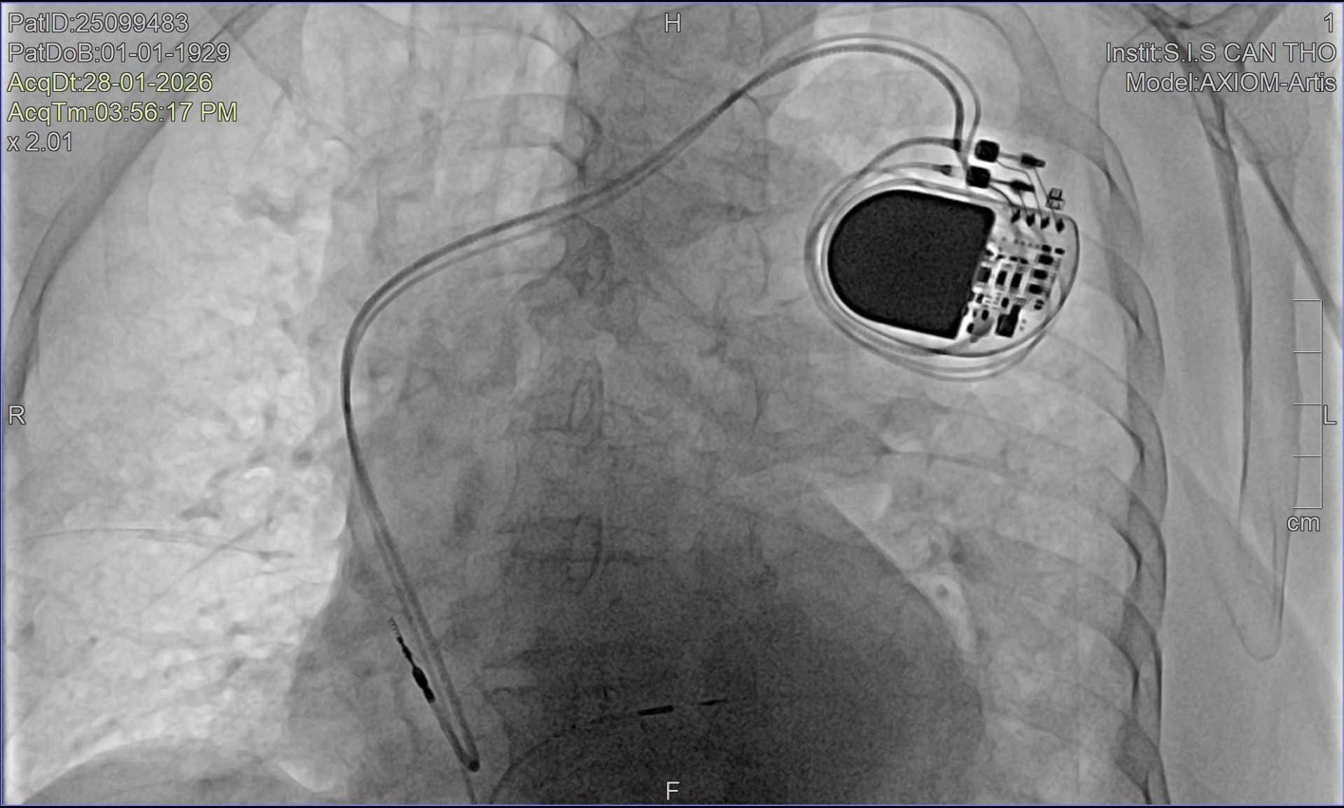 Bệnh viện S.I.S Cần Thơ cứu thành công bệnh nhân lớn tuổi tim loạn nhịp