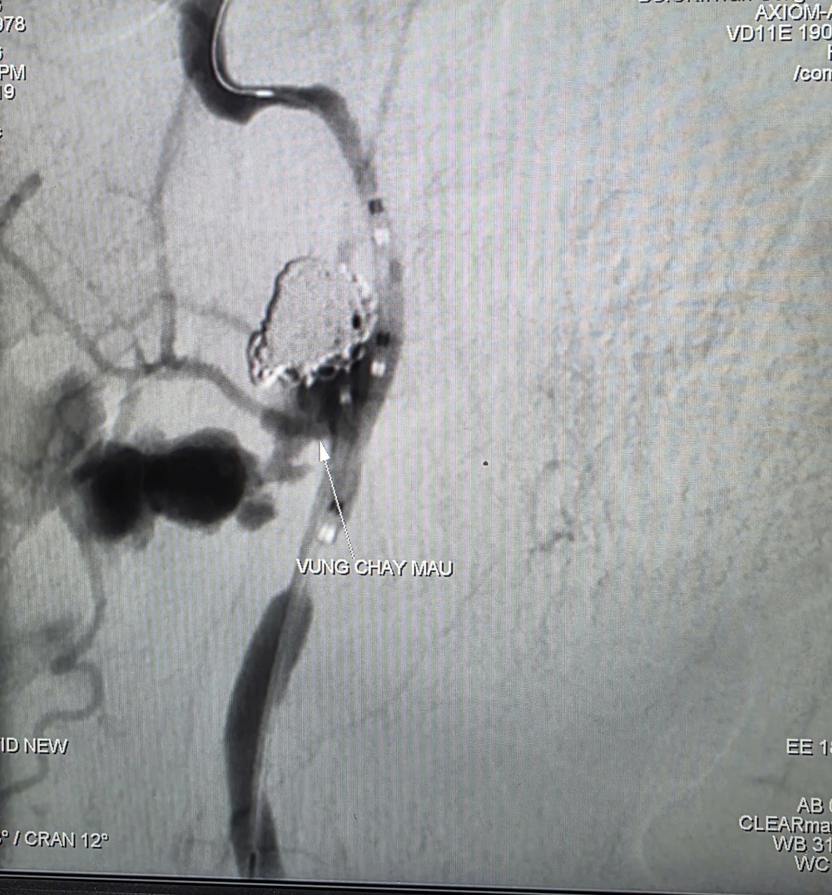 90 phút can thiệp mạch giành lại sự sống cho bệnh nhân xuất huyết nguy kịch
