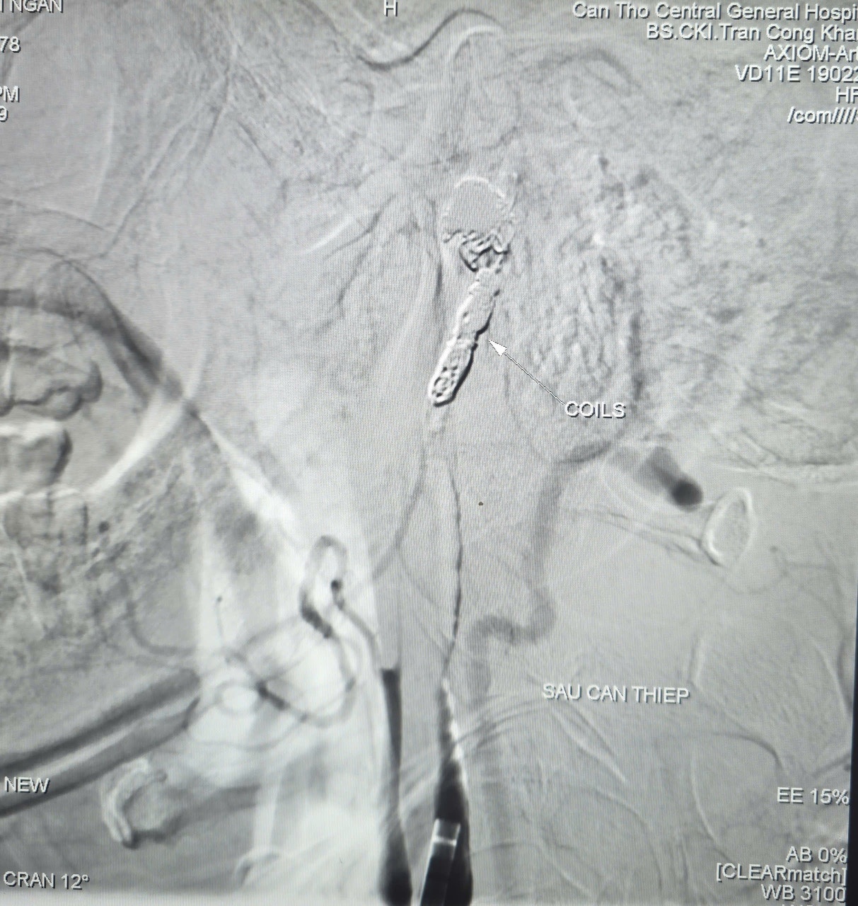 90 phút can thiệp mạch giành lại sự sống cho bệnh nhân xuất huyết nguy kịch