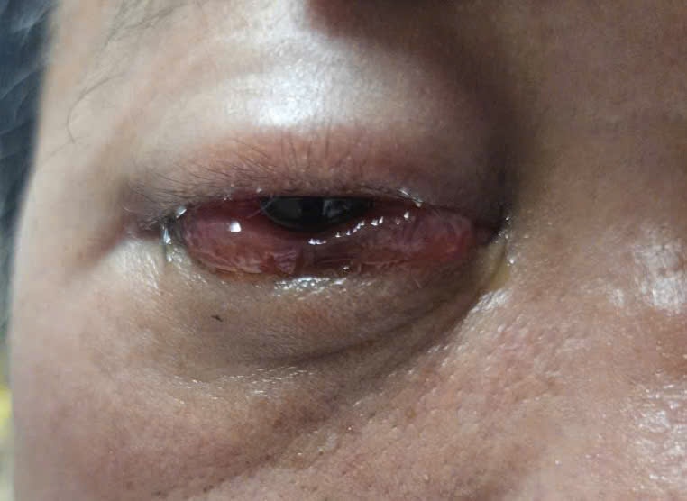 Bệnh viện Quân y 121 làm chủ kỹ thuật nút rò động mạch cảnh xoang hang