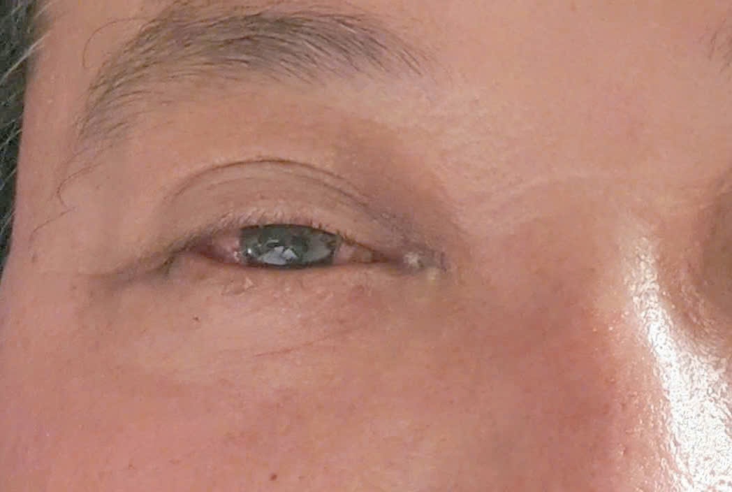 Bệnh viện Quân y 121 làm chủ kỹ thuật nút rò động mạch cảnh xoang hang