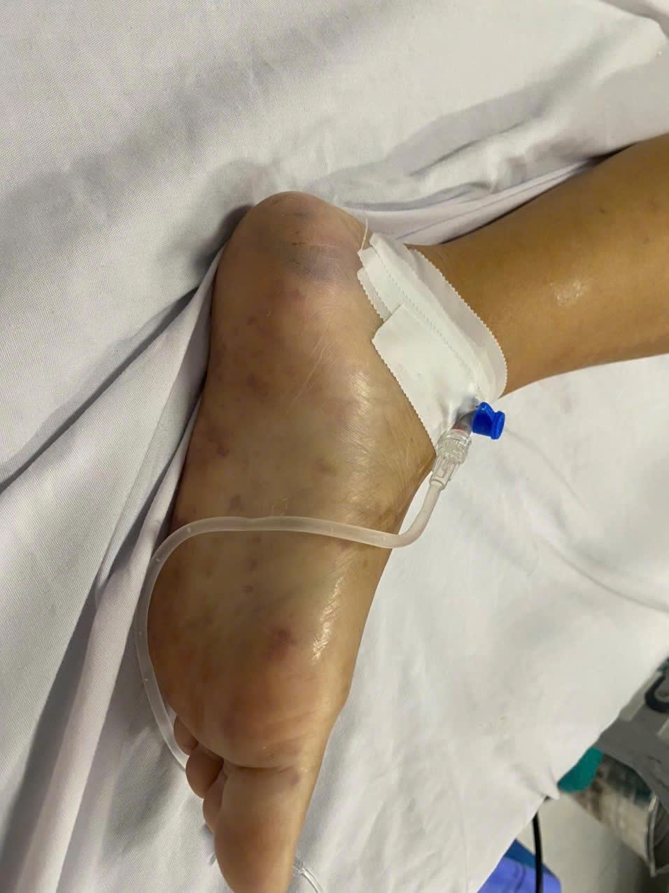 Giành lại sự sống cho bệnh nhân nhiễm não mô cầu type B nguy kịch