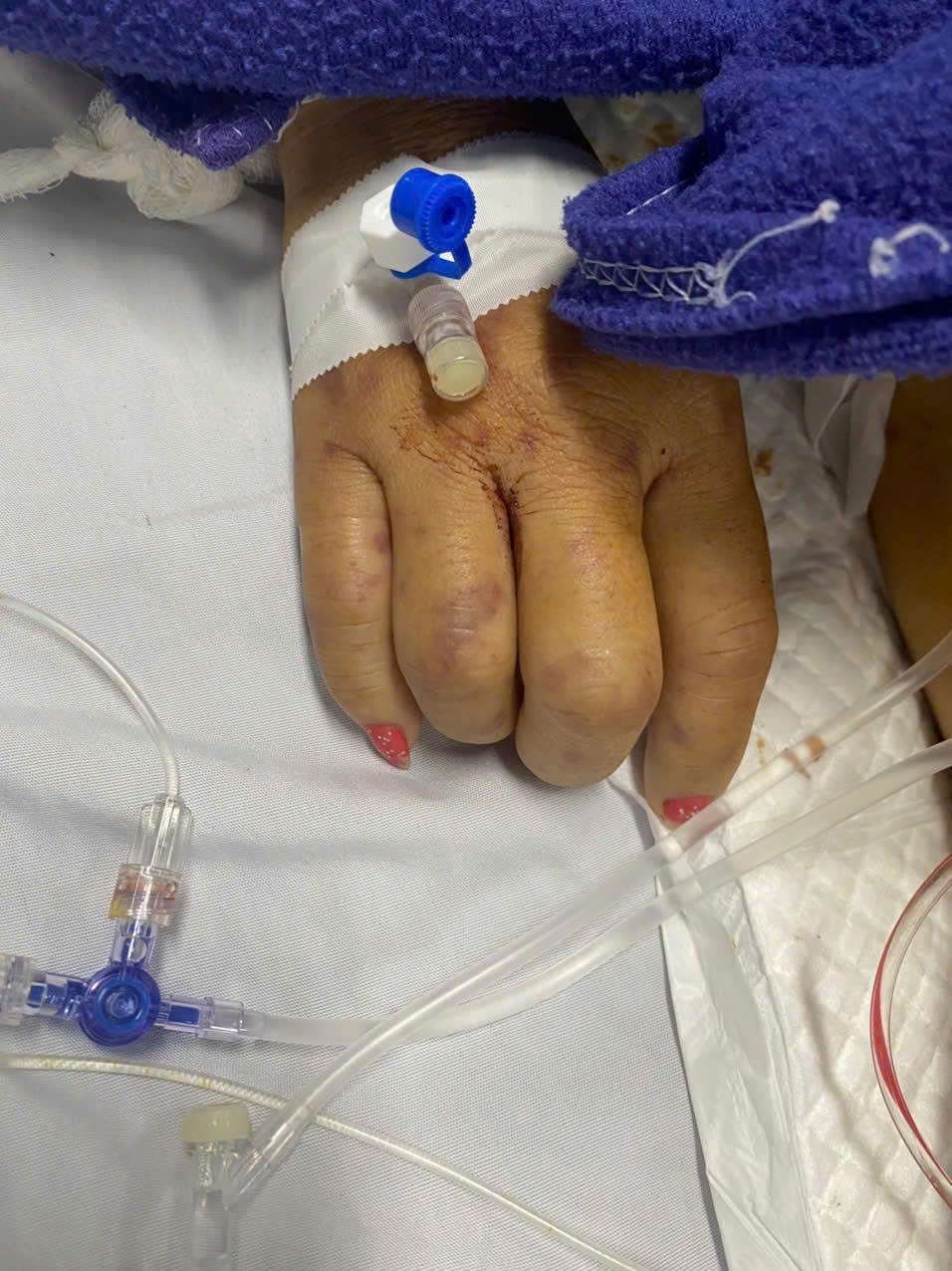 Giành lại sự sống cho bệnh nhân nhiễm não mô cầu type B nguy kịch