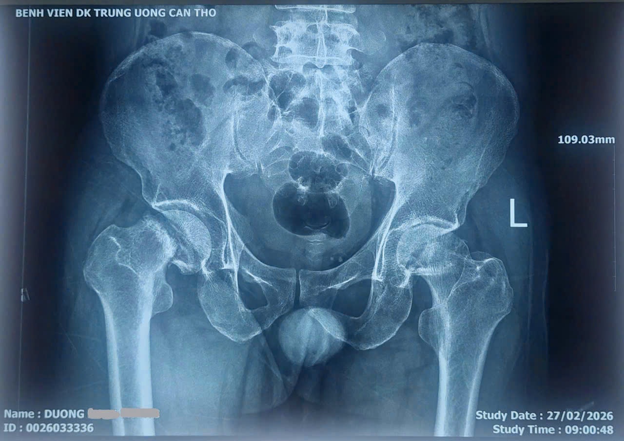 Thay khớp háng hai bên trong một ca mổ, bệnh nhân đi lại sau 2 ngày