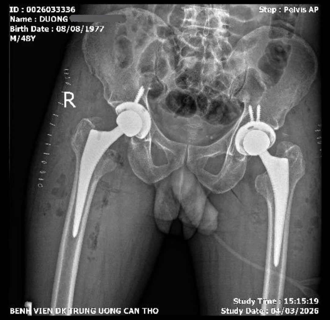 Thay khớp háng hai bên trong một ca mổ, bệnh nhân đi lại sau 2 ngày