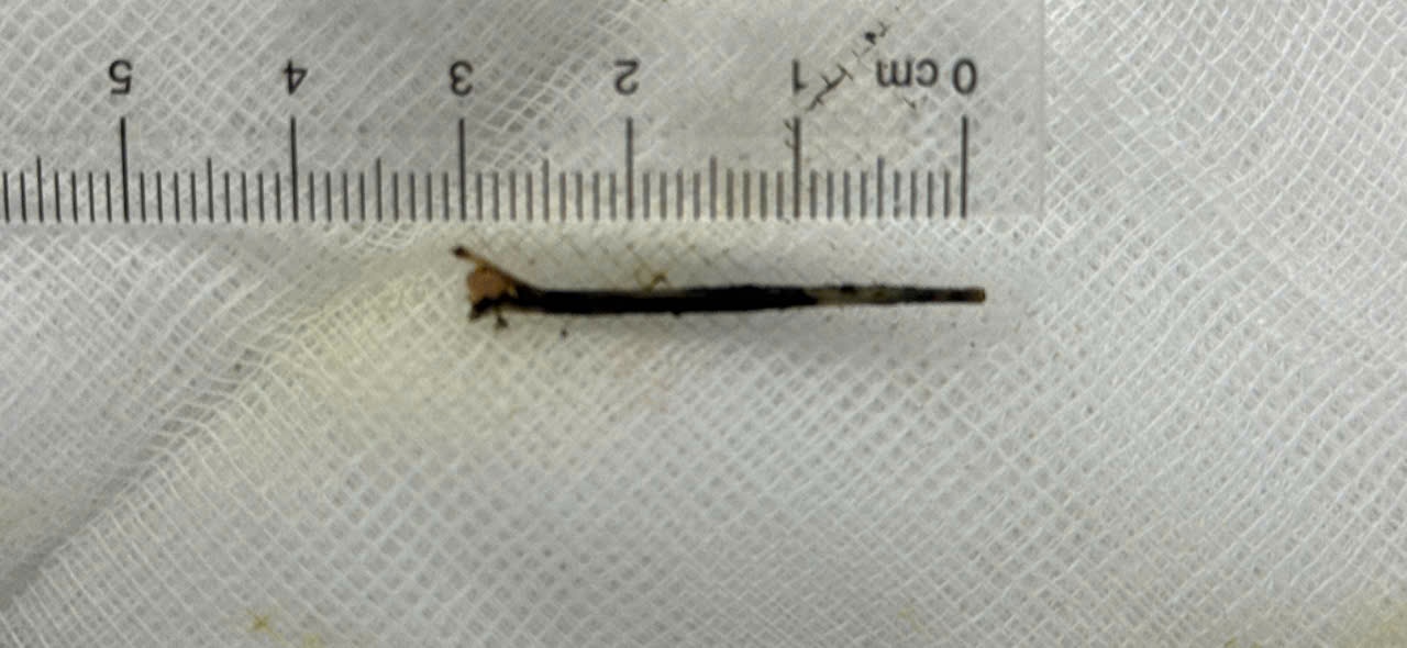 Nội soi gắp xương cá xuyên dạ dày vào đường mật Nội soi gắp xương cá xuyên dạ dày vào đường mật