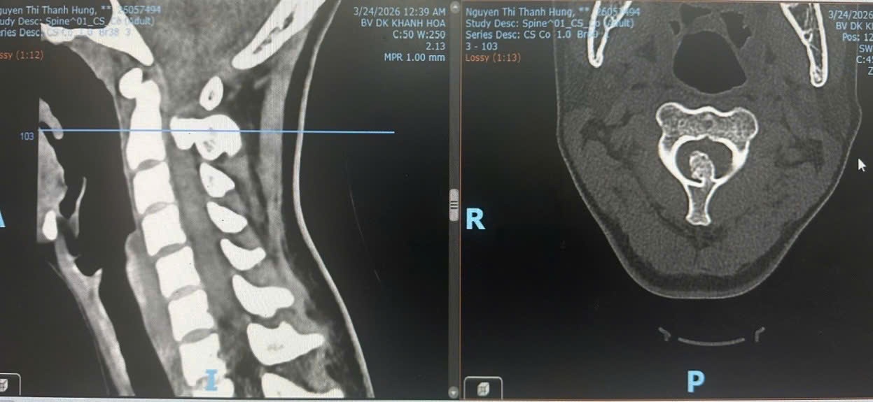 Bệnh nhân liệt tứ chi do u xương đốt sống cổ được phẫu thuật thành công Bệnh nhân liệt tứ chi do u xương đốt sống cổ được phẫu thuật thành công