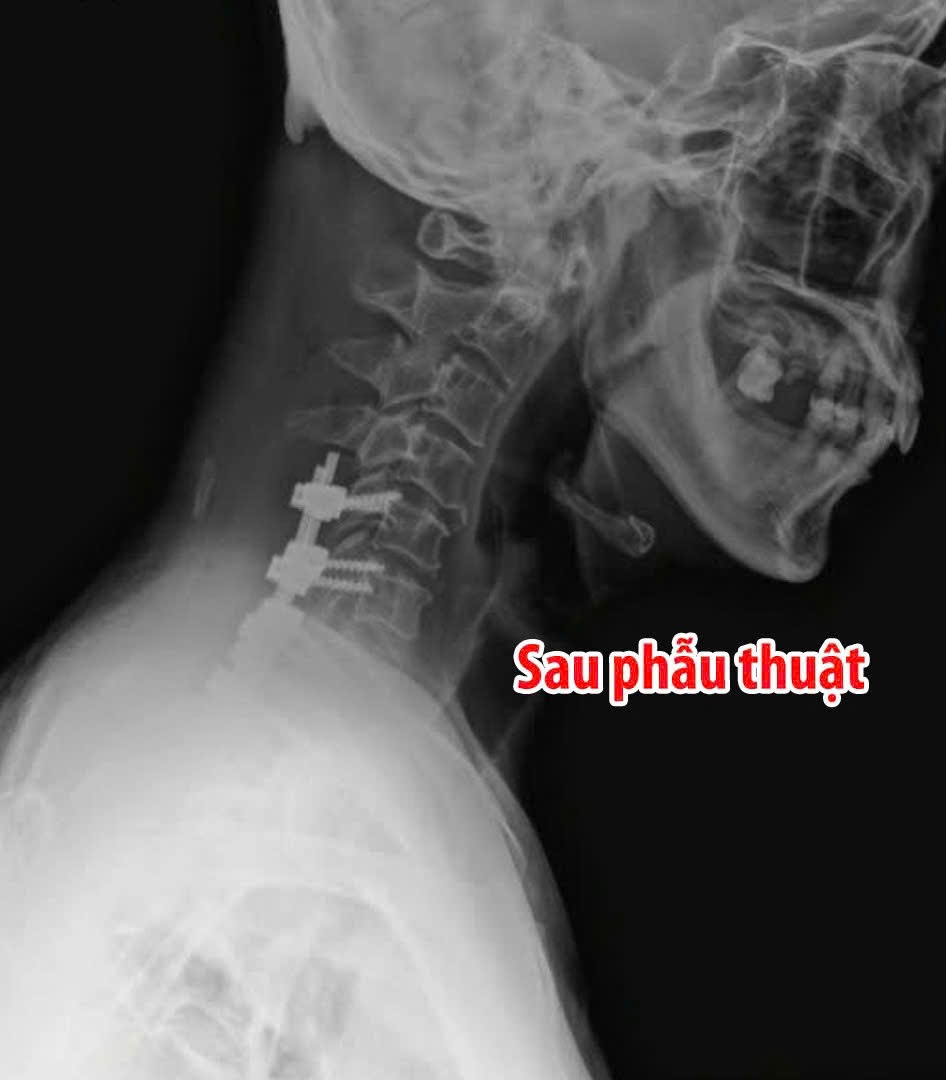 Bệnh viện Đa khoa Tâm Trí Nha Trang: Phẫu thuật thành công ca u tủy cổ, liệt tứ chi cho bệnh nhân