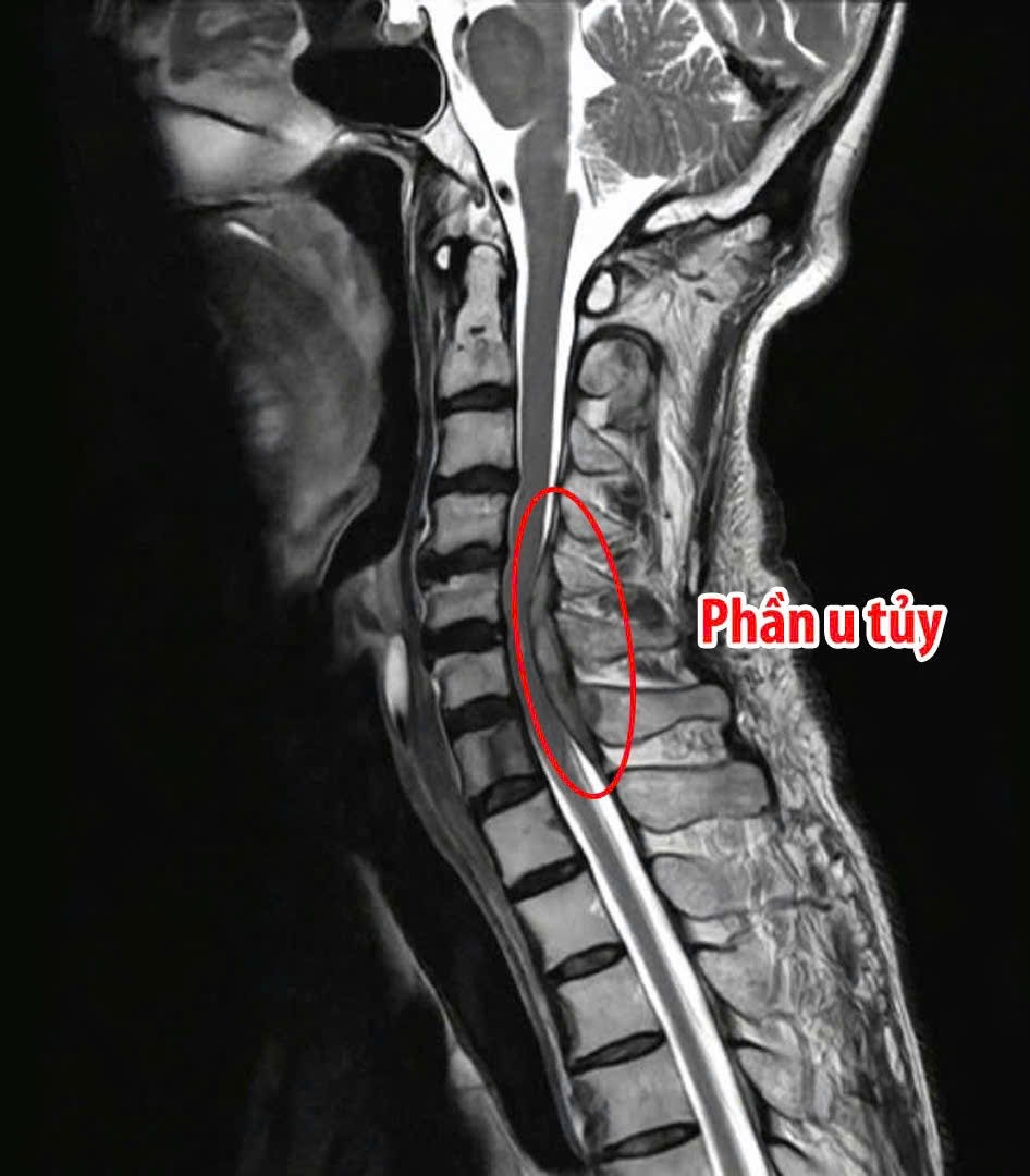 Bệnh viện Đa khoa Tâm Trí Nha Trang: Phẫu thuật thành công ca u tủy cổ, liệt tứ chi cho bệnh nhân