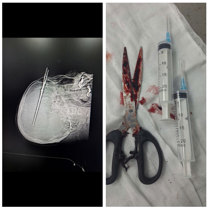 Kỳ tích y khoa: Cứu sống bệnh nhân bị dị vật nguy hiểm xuyên não