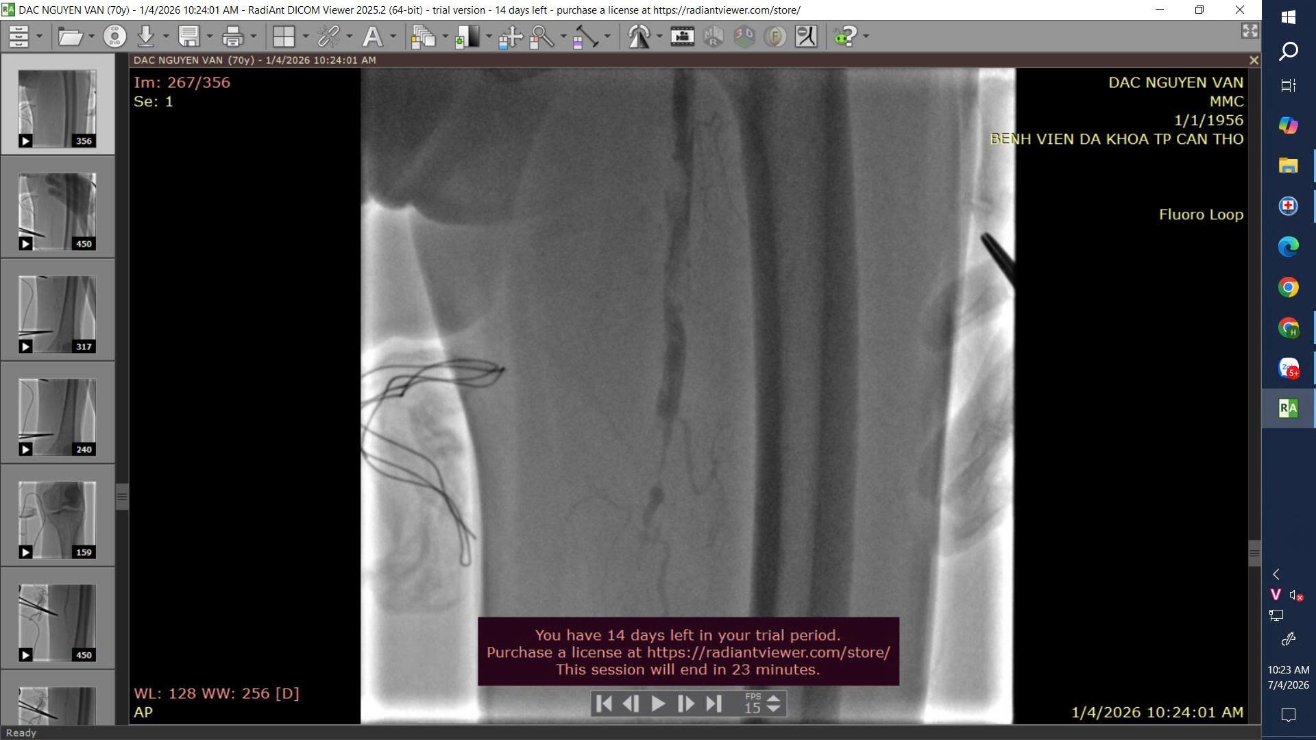 Thoát nguy cơ cắt cụt chi, bệnh nhân 70 tuổi giữ được chân nhờ can thiệp kịp thời Thoát nguy cơ cắt cụt chi, bệnh nhân 70 tuổi giữ được chân nhờ can thiệp kịp thời