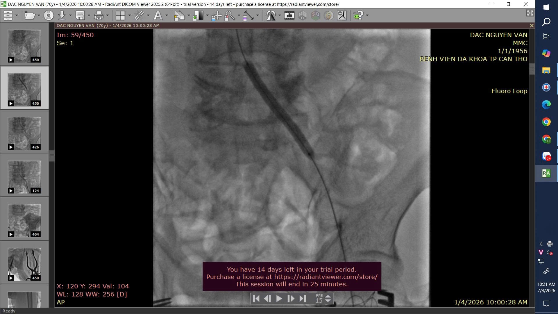 Thoát nguy cơ cắt cụt chi, bệnh nhân 70 tuổi giữ được chân nhờ can thiệp kịp thời Thoát nguy cơ cắt cụt chi, bệnh nhân 70 tuổi giữ được chân nhờ can thiệp kịp thời