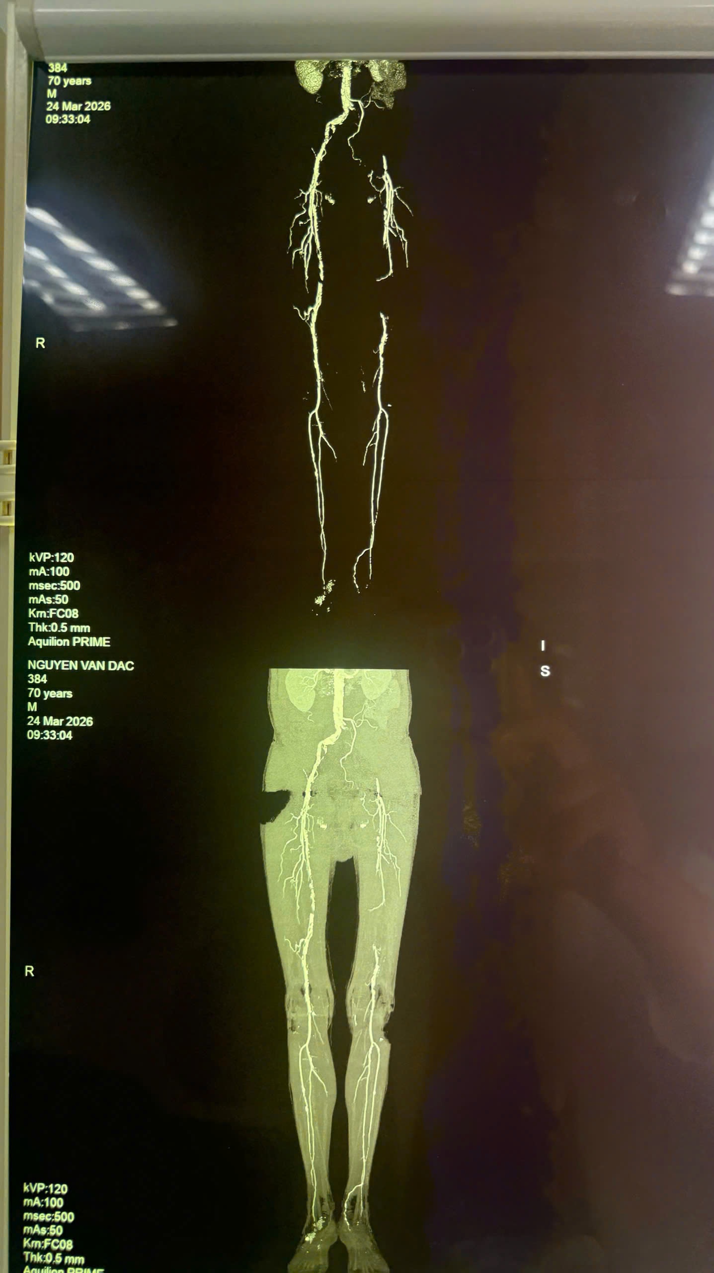 Thoát nguy cơ cắt cụt chi, bệnh nhân 70 tuổi giữ được chân nhờ can thiệp kịp thời Thoát nguy cơ cắt cụt chi, bệnh nhân 70 tuổi giữ được chân nhờ can thiệp kịp thời