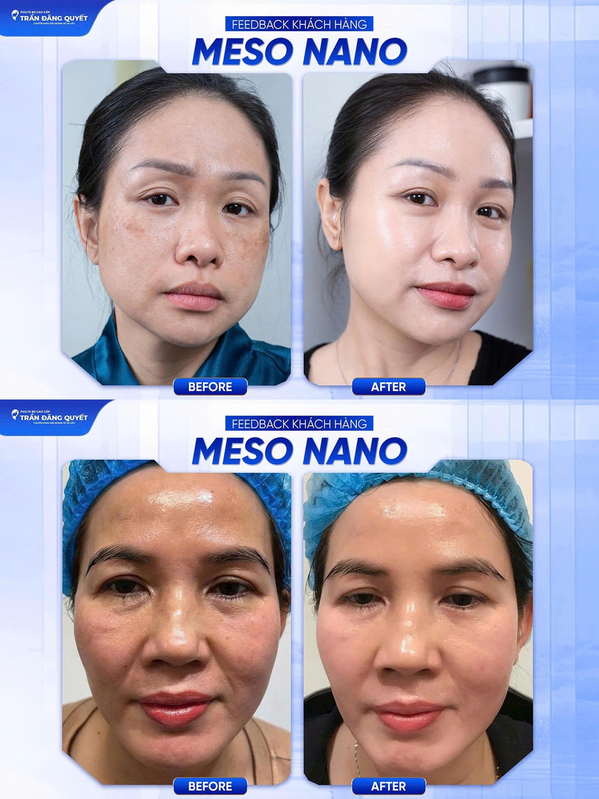 Hiệu quả điều trị nám và trẻ hoá da bằng phương pháp Meso Nano kết hợp CNC Hiệu quả điều trị nám và trẻ hoá da bằng phương pháp Meso Nano kết hợp CNC