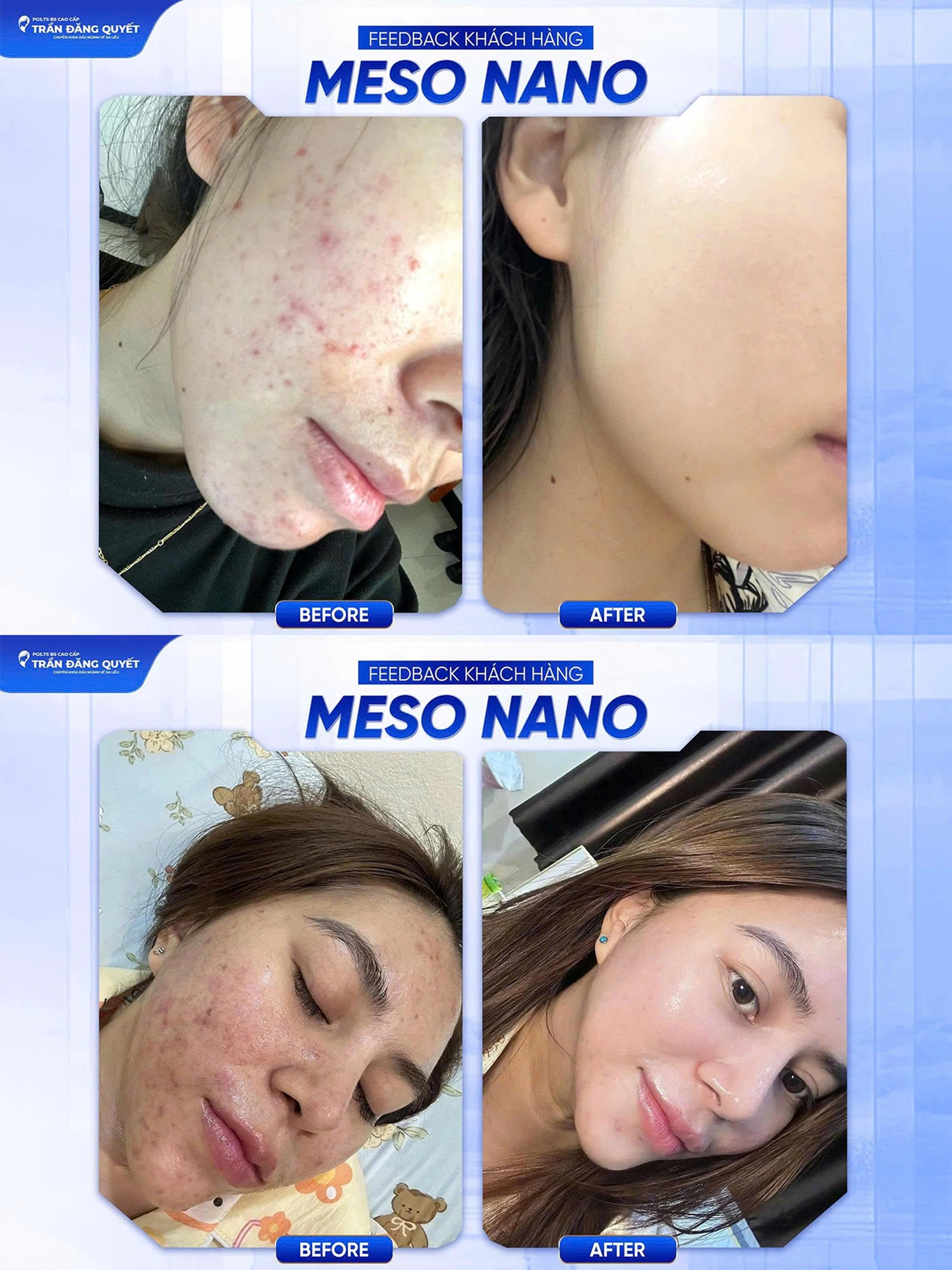 Hiệu quả điều trị mụn và sẹo bằng phương pháp Meso Nano kết hợp CNC Hiệu quả điều trị mụn và sẹo bằng phương pháp Meso Nano kết hợp CNC