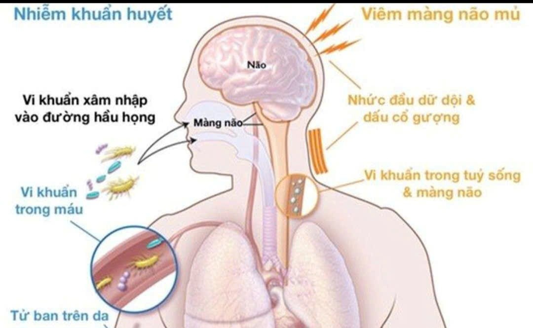 Cảnh báo nguy cơ gia tăng bệnh do não mô cầu: Chủ động phòng ngừa để bảo vệ sức khỏe cộng đồng