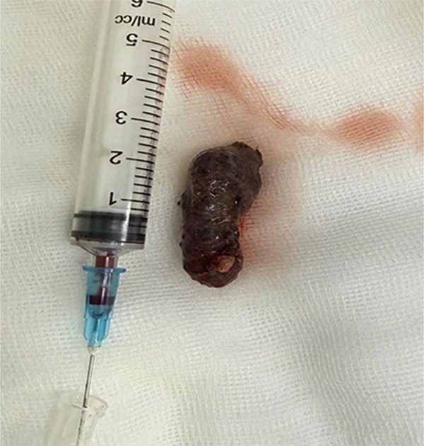    Hình ảnh khối u sau khi được bác sĩ và ê kíp phẫu thuật bóc tách ra khỏi hốc mắt  ẢNH: BVCC