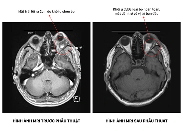 Ca phẫu thuật 4 giờ dưới kính vi phẫu giải cứu đôi mắt bị khối u chèn ép