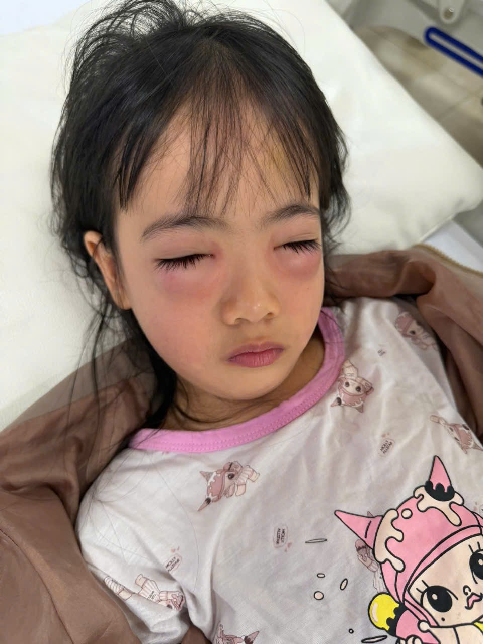 Bé gái bị sưng đỏ hai mắt, viêm kết mạc dị ứng cấp tính sau khi tiếp xúc với dung dịch từ đồ chơi bong bóng xà phòng không rõ nguồn gốc. Bé gái bị sưng đỏ hai mắt, viêm kết mạc dị ứng cấp tính sau khi tiếp xúc với dung dịch từ đồ chơi bong bóng xà phòng không rõ nguồn gốc.