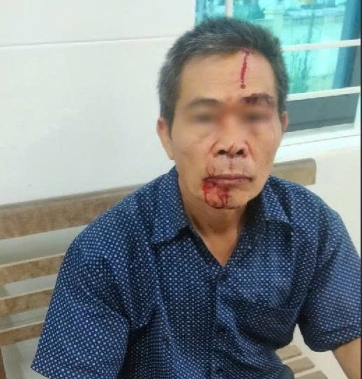 Ông Phan Chí Thanh bị ông Nguyễn Thái Bình (bố của Anh Tuân) cầm ghế lim đánh vào đầu Ông Phan Chí Thanh bị ông Nguyễn Thái Bình (bố của Anh Tuân) cầm ghế lim đánh vào đầu