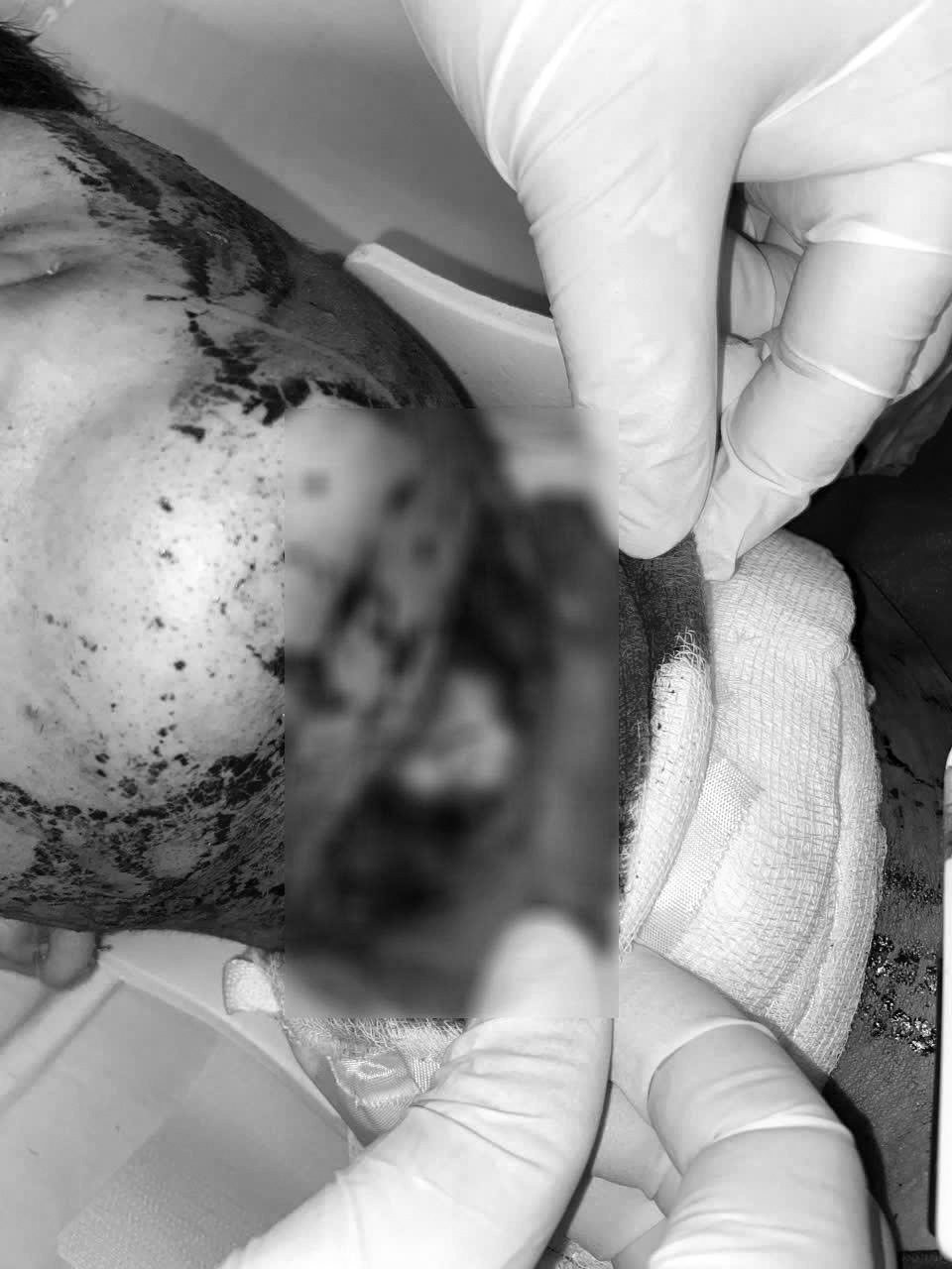 Cần Thơ cứu sống bệnh nhân bị chấn thương cổ xuyên thấu nghiêm trọng