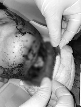 Cần Thơ cứu sống bệnh nhân bị chấn thương cổ xuyên thấu nghiêm trọng