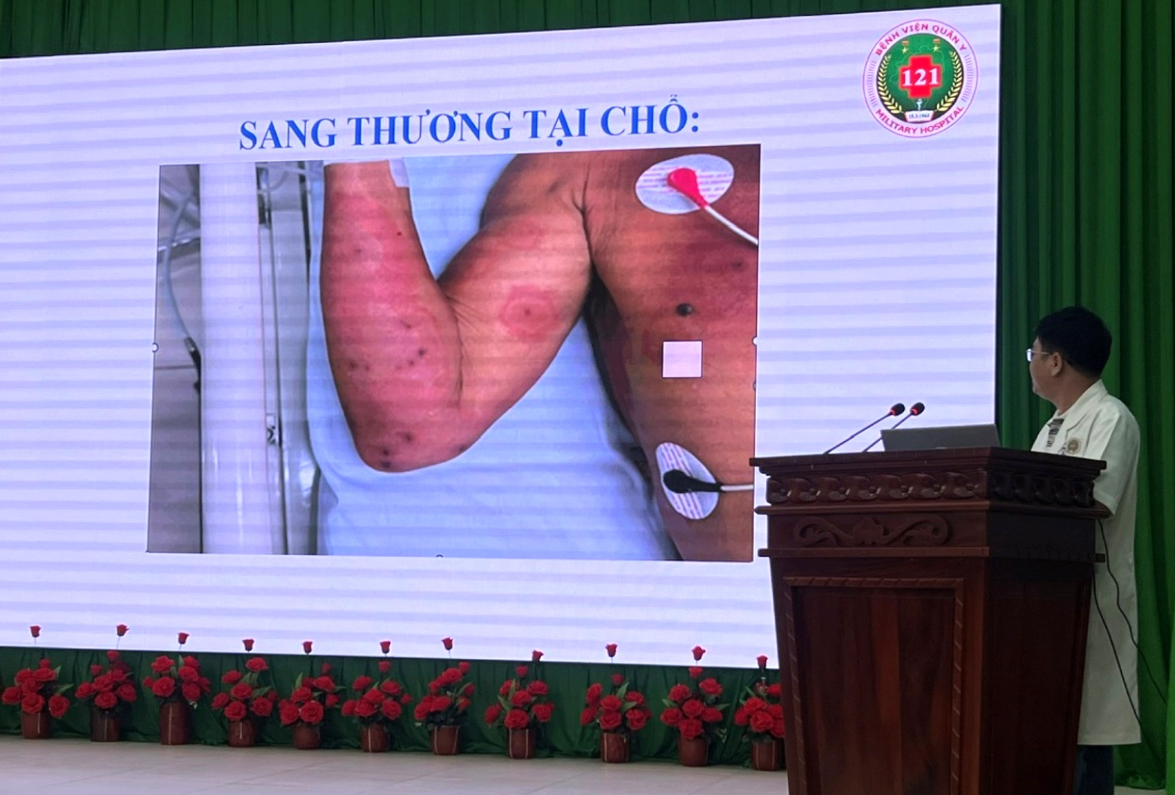 Hy hữu: Bệnh viện Quân y 121, Cục Hậu cần - Kỹ thuật (Quân khu 9) cứu sống bệnh nhân bị ong vò vẽ đốt 150 vết Hy hữu: Bệnh viện Quân y 121, Cục Hậu cần - Kỹ thuật (Quân khu 9) cứu sống bệnh nhân bị ong vò vẽ đốt 150 vết