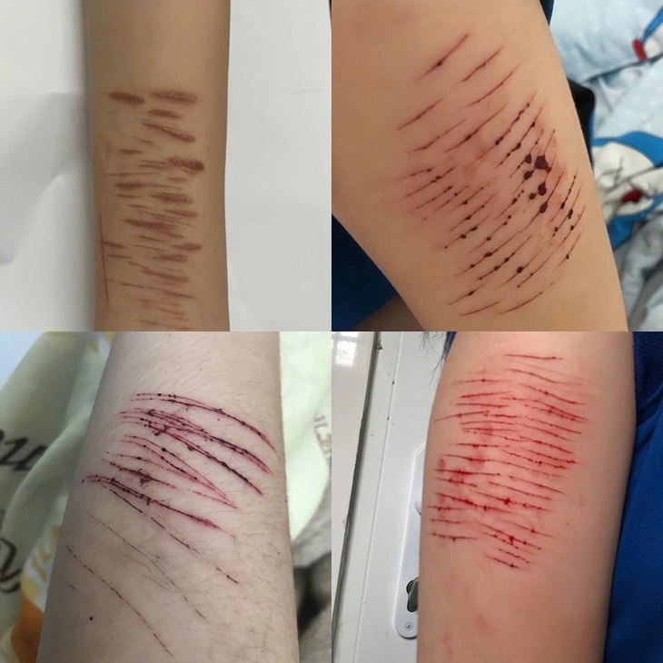 Trẻ vị thành niên và hành vi tự gây thương tích: Đừng để mạng xã hội thay thế kết nối gia đình Trẻ vị thành niên và hành vi tự gây thương tích: Đừng để mạng xã hội thay thế kết nối gia đình