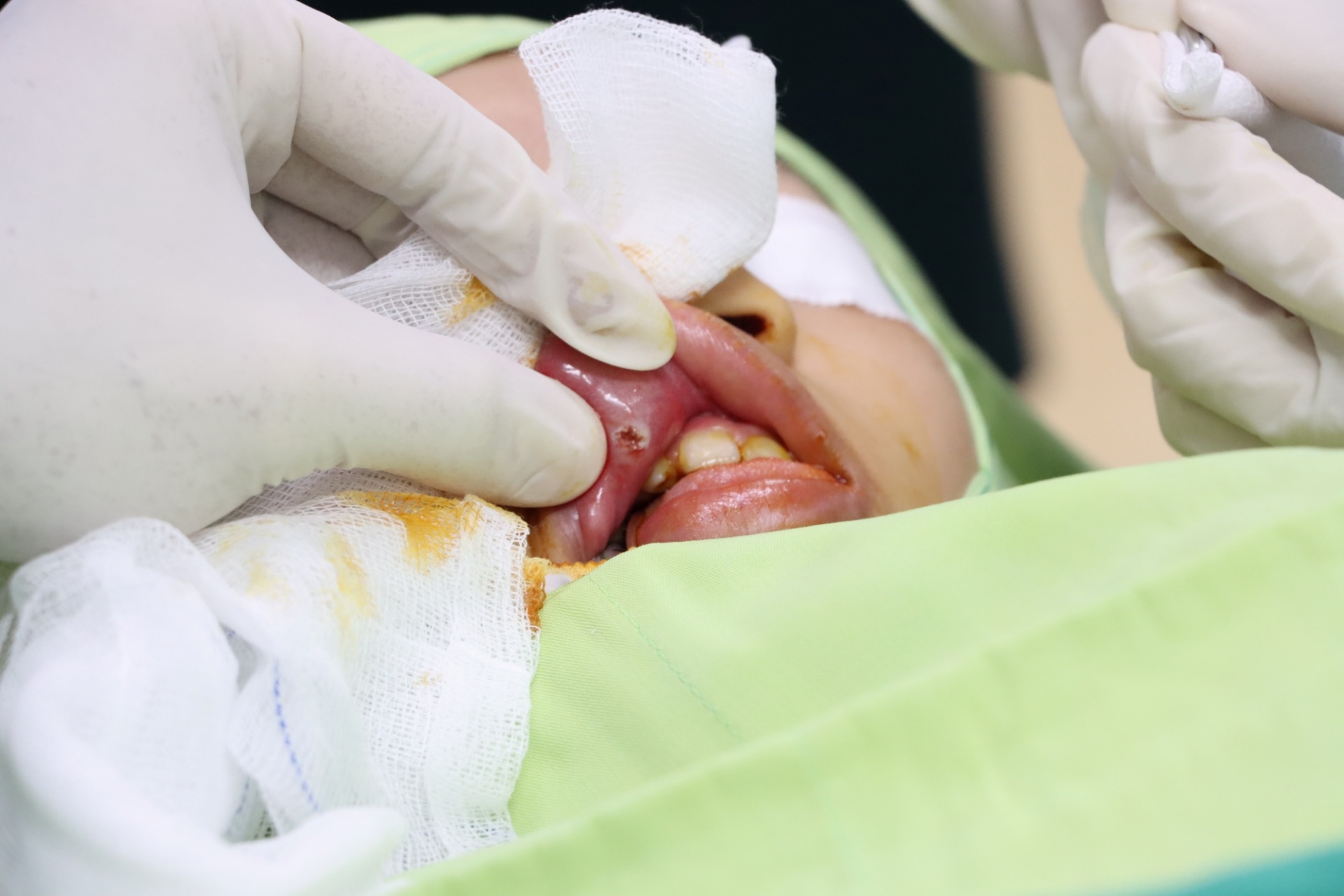 Bé gái đạp xe đi chơi bất ngờ bị bi sắt bắn trúng môi